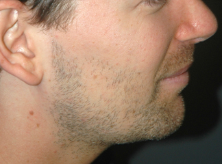 chin implant male after photo patient